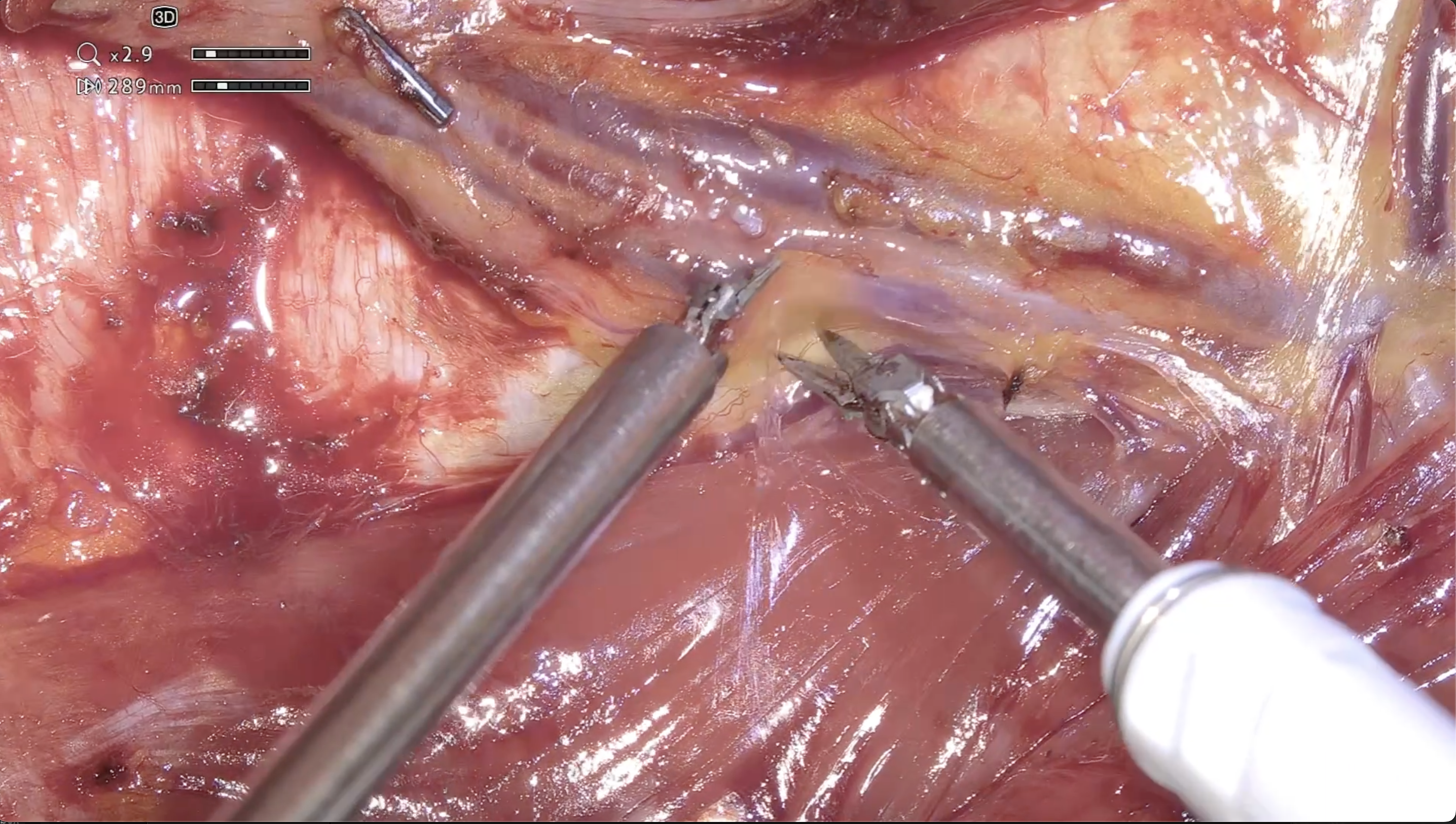 Pedicle Dissection_Fran Ruccia Case